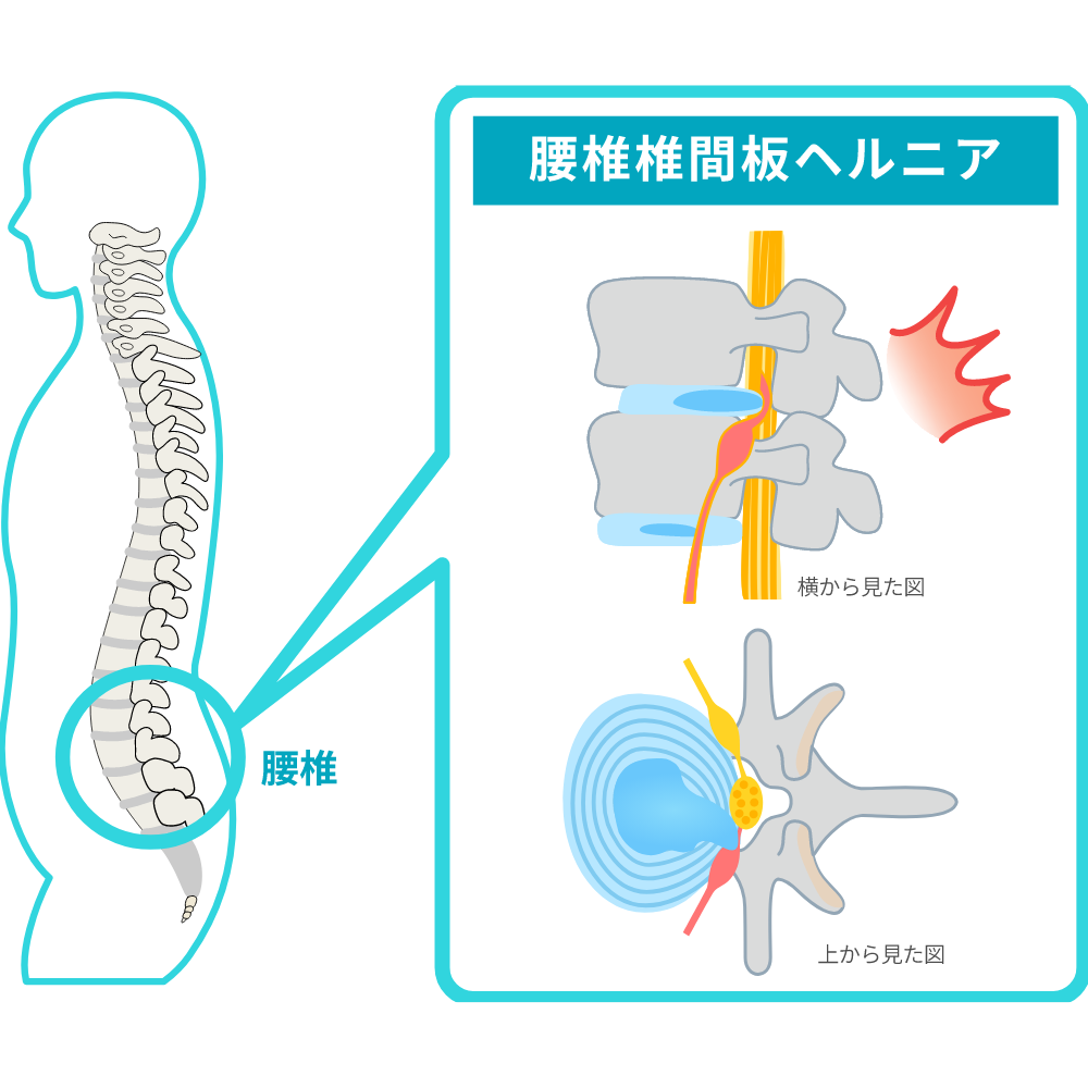 椎間板ヘルニア